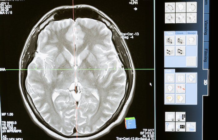 Neuroplasticity, brain, scan, xray, brain pathways, path